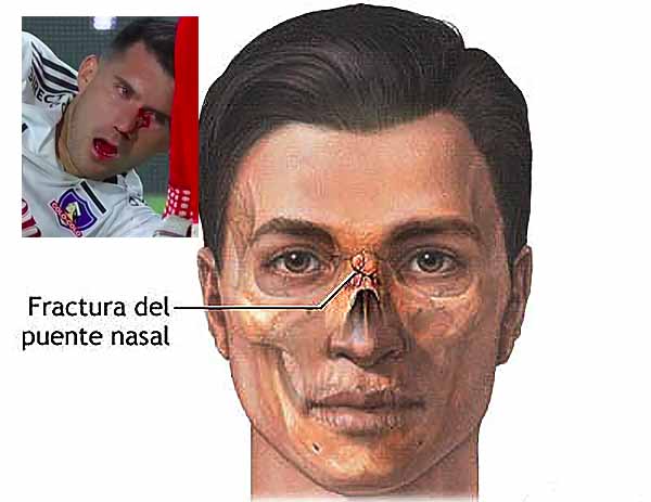 Fractura nasal