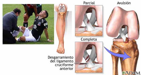 Rotura de ligamento cruzado anterior